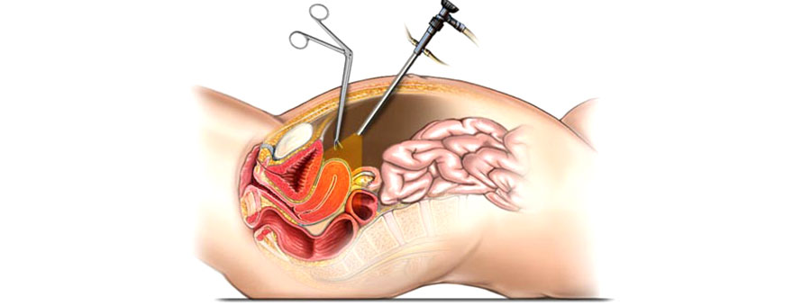 Laparoscopic Hysterectomy